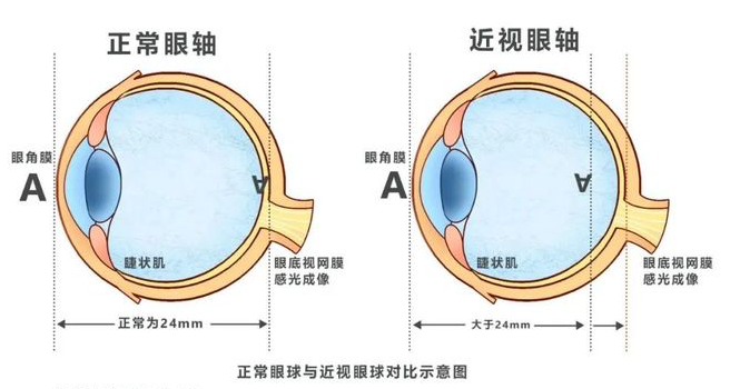 近视眼最新技术，重塑视觉世界的希望之光探索